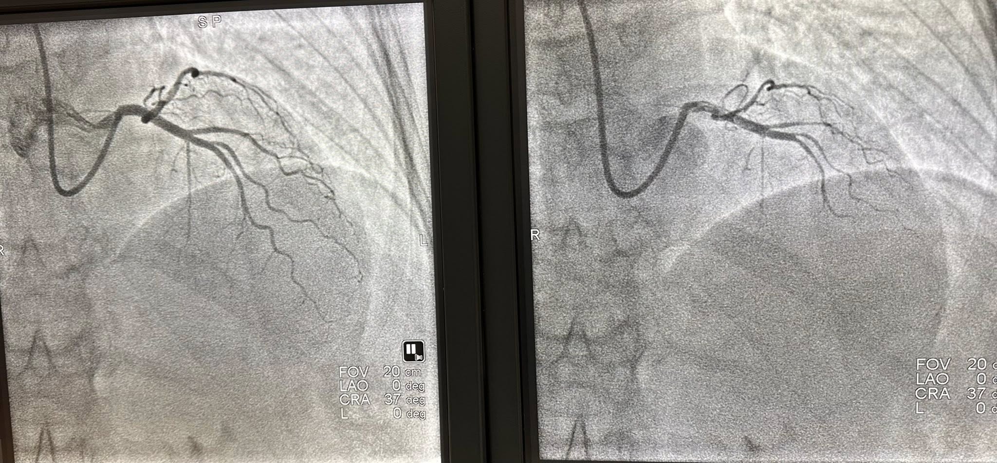 Dr Aleksandar Janjičić: Bijeljina dobila prvi Centar za procjenu invazivne koronarne fiziologije u BiH - Ogroman iskorak za našu bolnicu i pacijente (foto) 8 514871826 10235757098058868 6292386939007289202 n