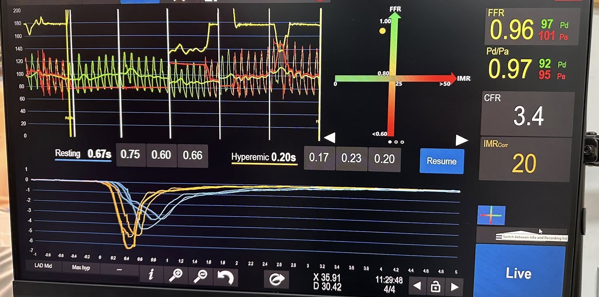 Dr Aleksandar Janjičić: Bijeljina dobila prvi Centar za procjenu invazivne koronarne fiziologije u BiH - Ogroman iskorak za našu bolnicu i pacijente (foto) 9 srce pregled ultrazvuk